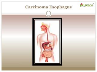 Carcinoma Esophagus