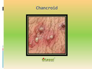 Chancroid