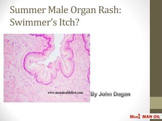 Summer Male Organ Rash: Swimmerâ€™s Itch?