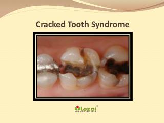 Cracked Tooth Syndrome