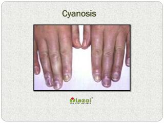 Cyanosis