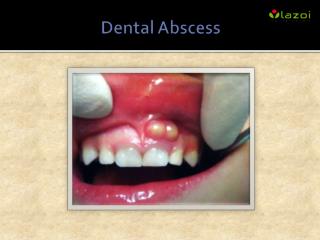 Dental Abscess