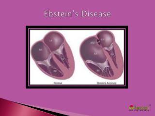 Ebsteinâ€™s Disease