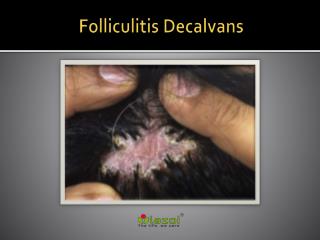 Folliculitis Decalvans