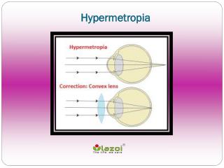 Hypermetropia: Causes, Symptoms, Daignosis, Prevention and Treatment