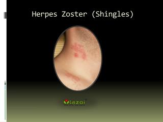 Herpes Zoster (Shingles) : Causes, Symptoms and Treatment
