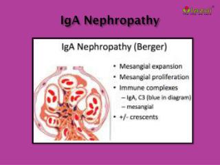 IgA Nephropathy: Causes, Symptoms, Daignosis, Prevention and Treatment