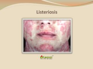 Listeriosis : Causes, Symptoms, Daignosis, Prevention and Treatment