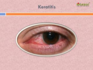 Keratitis: Causes, Symptoms, Daignosis, Prevention and Treatment