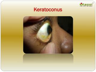 Keratoconus: Causes, Symptoms, Daignosis, Prevention and Treatment