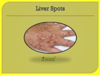 Liver Spots : Causes, Symptoms, Daignosis, Prevention and Treatment