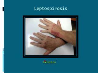 Leptospirosis : Causes, Symptoms, Daignosis, Prevention and Treatment