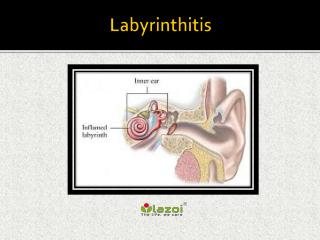 Labyrinthitis: Causes, Symptoms, Daignosis, Prevention and Treatment