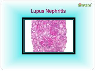 Lupus Nephritis: Causes, Symptoms, Daignosis, Prevention and Treatment