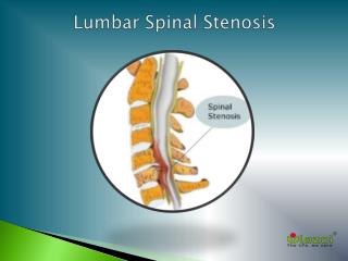 Lumbar Spinal Stenosis: Causes, Symptoms, Daignosis, Prevention and Treatment