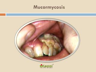Mucormycosis: Causes, Symptoms, Daignosis, Prevention and Treatment
