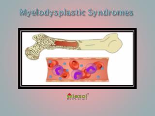 Myelodysplastic Syndromes: Causes, Symptoms, Daignosis, Prevention and Treatment