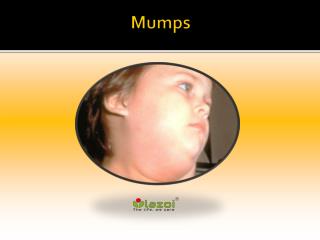 Mumps: Causes, Symptoms, Daignosis, Prevention and Treatment
