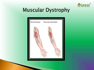 Muscular Dystrophy: Causes, Symptoms, Daignosis, Prevention and Treatment