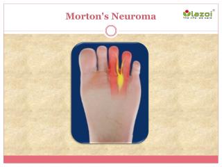 Mortonâ€™s Neuroma: Causes, Symptoms, Daignosis, Prevention and Treatment