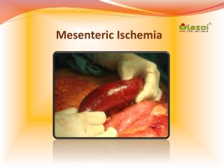 Mesenteric Ischemia: Causes, Symptoms, Daignosis, Prevention and Treatment