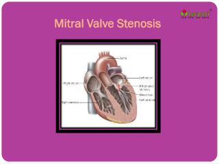 Mitral Valve Stenosis: Causes, Symptoms, Daignosis, Prevention and Treatment
