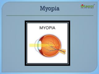 Myopia: Causes, Symptoms, Daignosis, Prevention and Treatment