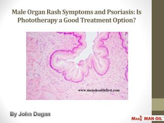 Male Organ Rash Symptoms and Psoriasis: Is Phototherapy a Good Treatment Option?