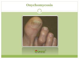 Onychomycosis: Causes, Symptoms, Daignosis, Prevention and Treatment