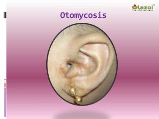 Otomycosis: Causes, Symptoms, Daignosis, Prevention and Treatment
