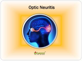 Optic neuritis: Learn about the symptoms, causes and treatment