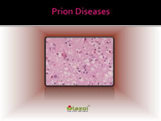 Prion Disease: Causes, Symptoms, Daignosis, Prevention and Treatment