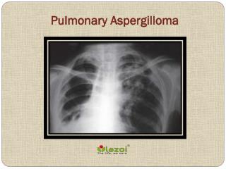 Pulmonary Aspergilloma: Causes, Symptoms, Daignosis, Prevention and Treatment