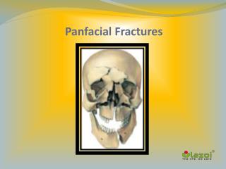 Panfacial Fractures: Causes, Symptoms, Daignosis, Prevention and Treatment