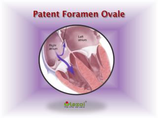 Patent Foramen Ovale: Causes, Symptoms, Daignosis, Prevention and Treatment