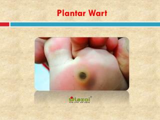 Plantar Wart: Causes, Symptoms, Daignosis, Prevention and Treatment