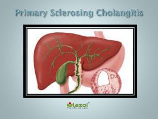 Primary Sclerosing Cholangitis: Causes, Symptoms, Daignosis, Prevention and Treatment