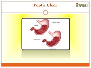 Peptic Ulcer: Causes, Symptoms, Daignosis, Prevention and Treatment