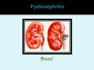 Pyelonephritis: Causes, Symptoms, Daignosis, Prevention and Treatment