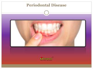What is Periodontal Disease? Read More about Symptoms and Treatment
