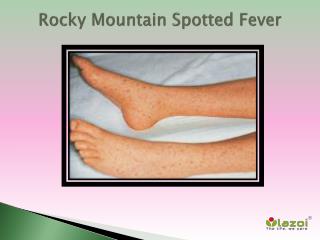 Rocky Mountain spotted fever: Causes, Symptoms, Daignosis, Prevention and Treatment