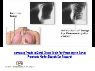 Increasing Trends In Global Clinical Trials For Pneumocystis Carinii Pneumonia Market Outlook: Ken Research