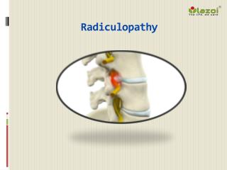 Radiculopathy: Causes, Symptoms, Daignosis, Prevention and Treatment