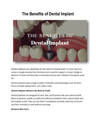 The Benefits of Dental Implant