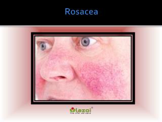 Rosacea: Causes, Symptoms, Daignosis, Prevention and Treatment