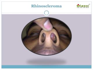 Rhinoscleroma: Causes, Symptoms, Daignosis, Prevention and Treatment