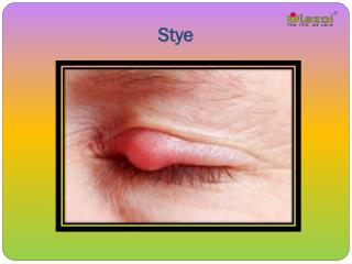 Stye: Causes, Symptoms, Daignosis, Prevention and Treatment