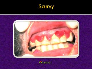 Scurvy: Causes, Symptoms, Daignosis, Prevention and Treatment