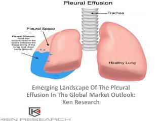 Global Pleural effusion Market Research Report, Analysis, Opportunities, Forecast, Size, Segmentation, Competitive Analy