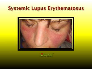 Systemic Lupus Erythematosus: Causes, Symptoms, Daignosis, Prevention and Treatment